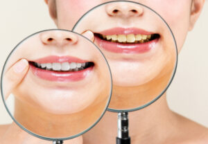 当院のホワイトニングの特長